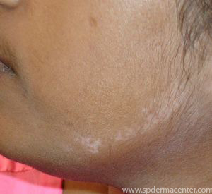 Vitiligo-Treated